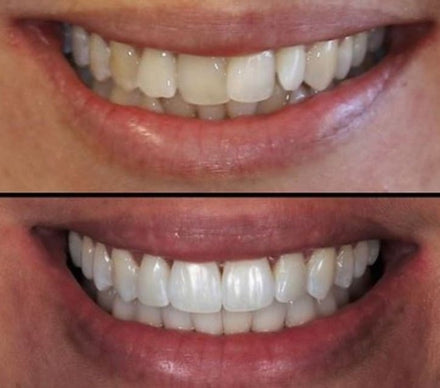 Before and after whitening result — Sarah M.