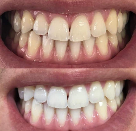 Before and after whitening result — James K.