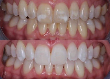 Before and after whitening result — Olivia T.