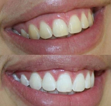 Before and after whitening result — Charlotte B.