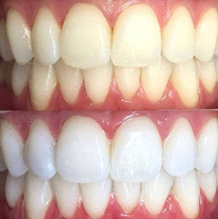 Before and after whitening result — Emily R.